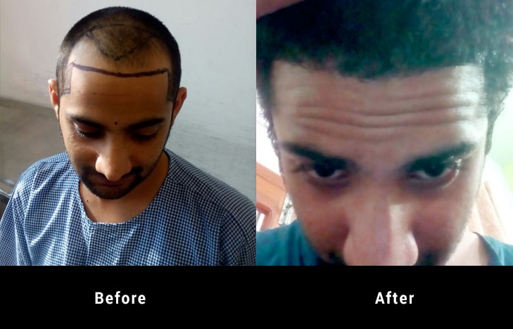 Before and after hair Transplant 