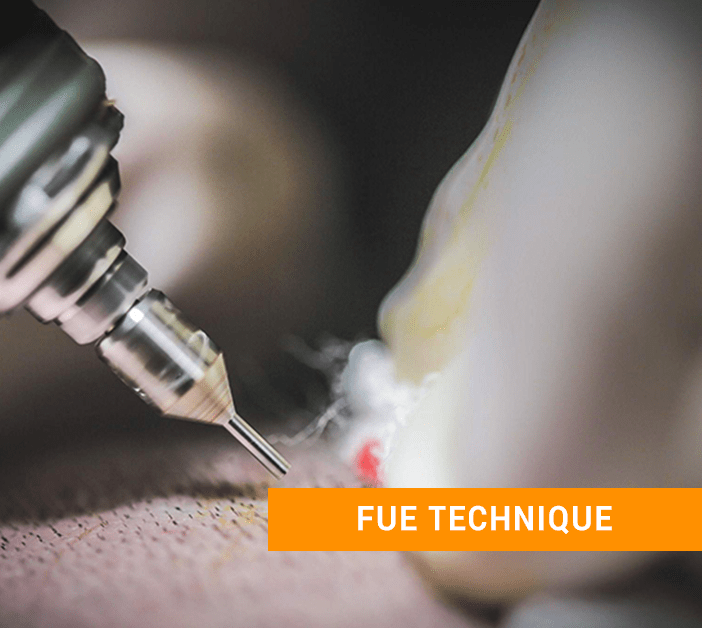 FUE hair transplant